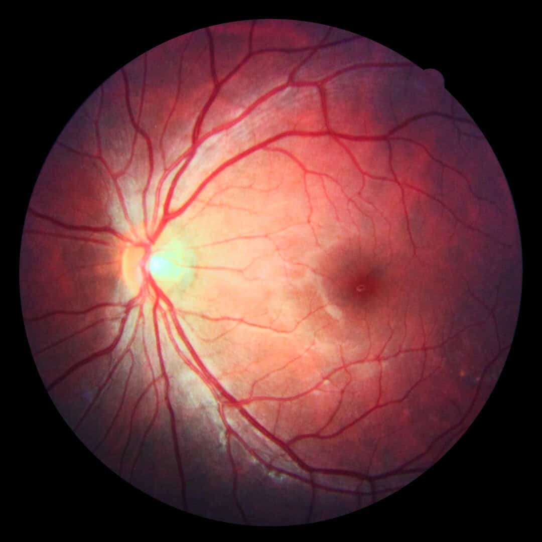 Il gene responsabile di una rara malattia oculare scoperto dagli scienziati del Nih 2 dreamstime m 34573814